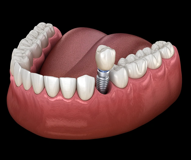 implant-restorations
