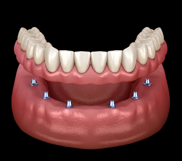 implant-supported-dentures